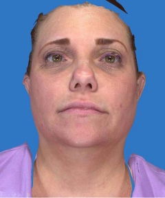 Before and After Facelift