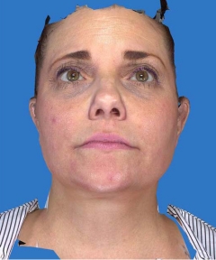 Before and After Facelift