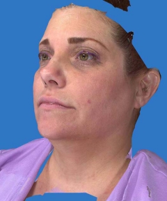 Before and After Facelift