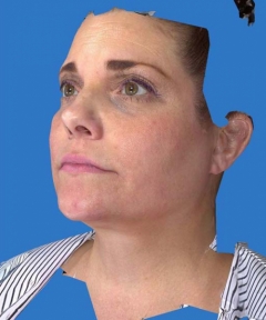 Before and After Facelift