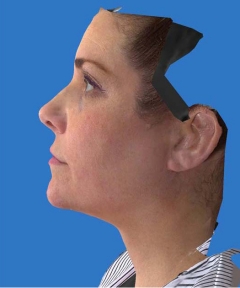 Before and After Facelift