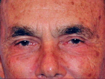 Facelift After