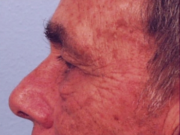 Before and After Facelift
