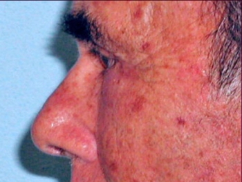 Before and After Facelift