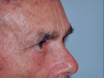 Facelift After