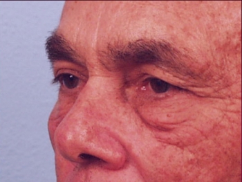 Before and After Facelift