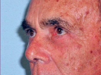 Before and After Facelift