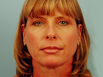 Before and After Facelift