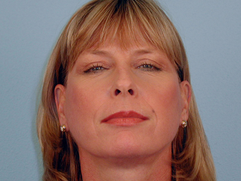 Before and After Facelift