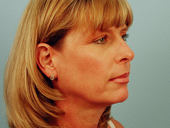 Before and After Facelift