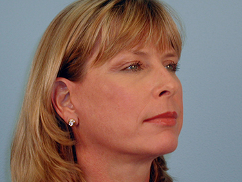 Before and After Facelift