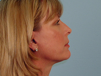 Before and After Facelift