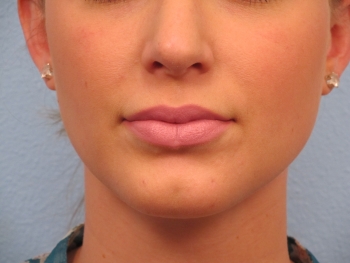 Lip Augmentation After