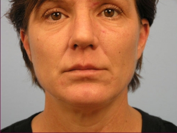 Before and After Lip Augmentation
