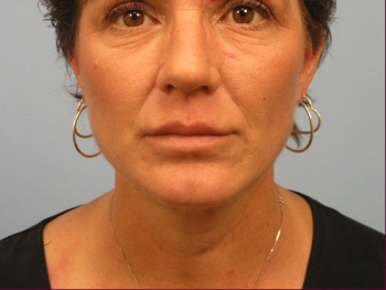 Before and After Lip Augmentation