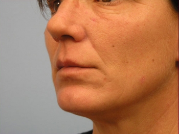 Before and After Lip Augmentation
