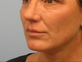 Before and After Lip Augmentation