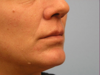 Before and After Lip Augmentation
