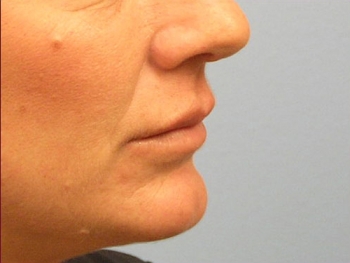 Before and After Lip Augmentation