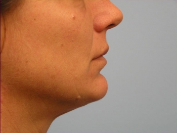 Before and After Lip Augmentation