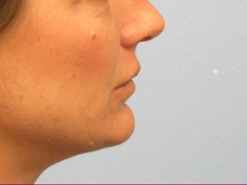 Before and After Lip Augmentation