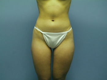 Liposuction Before