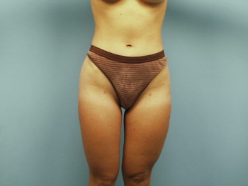 Liposuction After