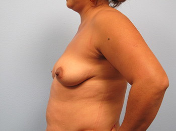 Before and After Mommy Makeover Naples, FL