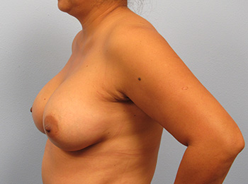 Before and After Mommy Makeover Naples, FL