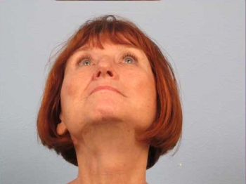 Before and After Rhinoplasty