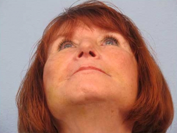 Before and After Rhinoplasty