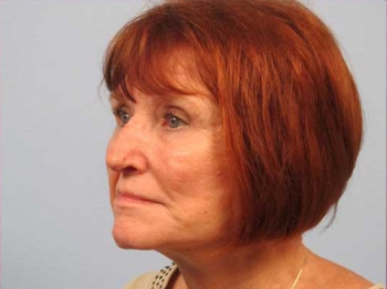 Before and After Rhinoplasty
