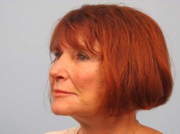Before and After Rhinoplasty