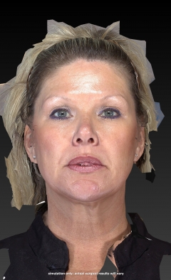 Before and After ThermiTight