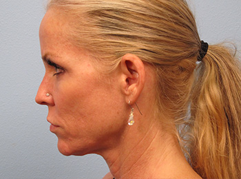Before and After ThermiTight
