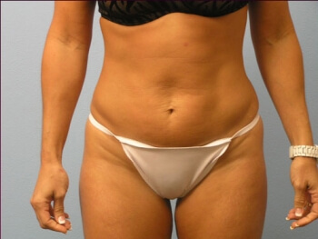 Tummy Tuck Before