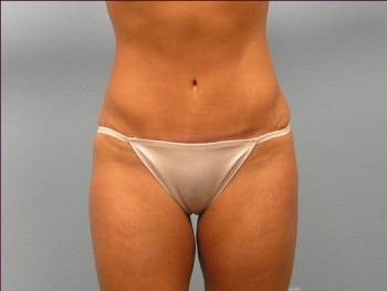 Tummy Tuck After