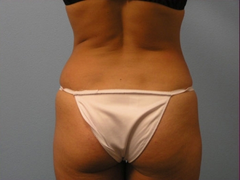 Before and After Tummy Tuck