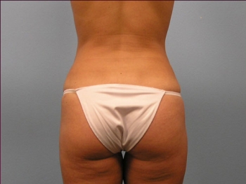 Before and After Tummy Tuck