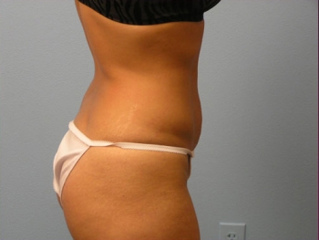 Before and After Tummy Tuck