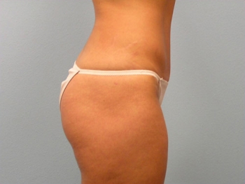 Before and After Tummy Tuck