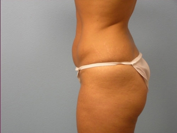 Before and After Tummy Tuck