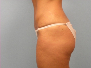 Before and After Tummy Tuck