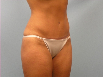 Before and After Tummy Tuck