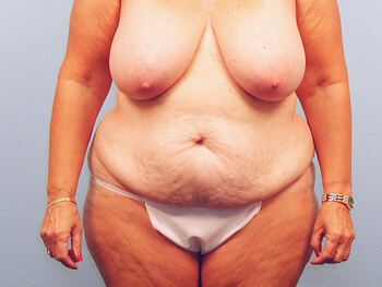 Before and After Tummy Tuck