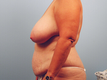 Before and After Tummy Tuck